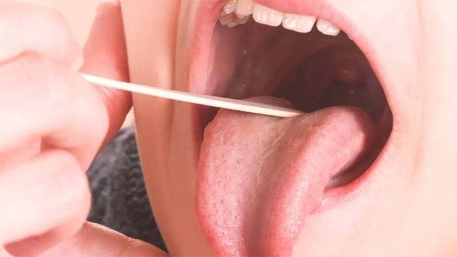 Aumentaron los casos invasivos por estreptococo en todo el país estreptococo pyogenes