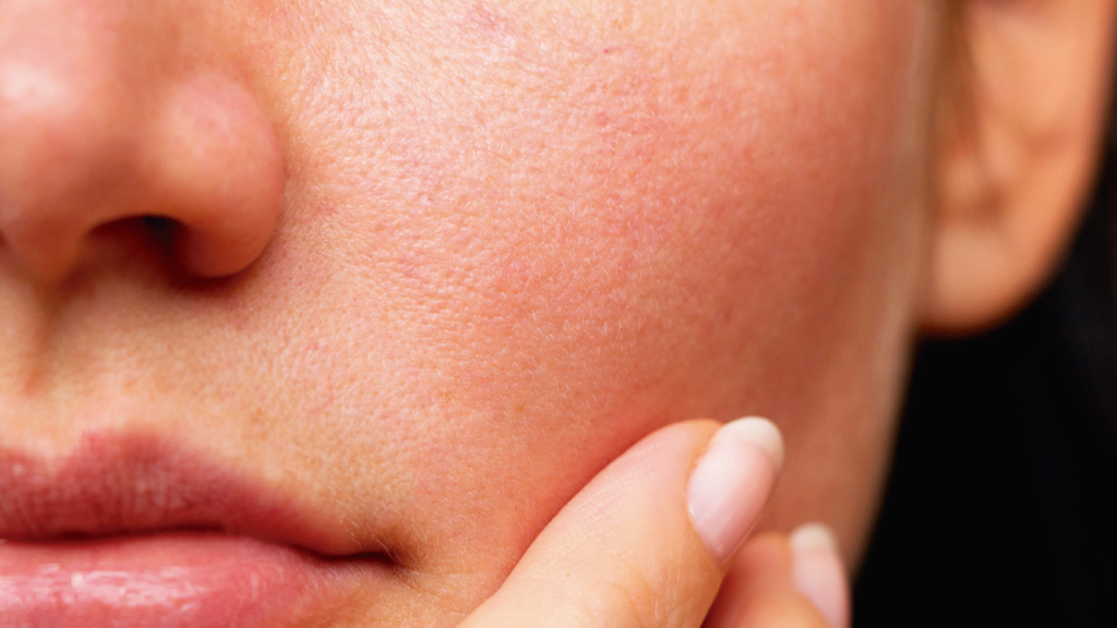 Consecuencias antiesteticas de la piel reseca