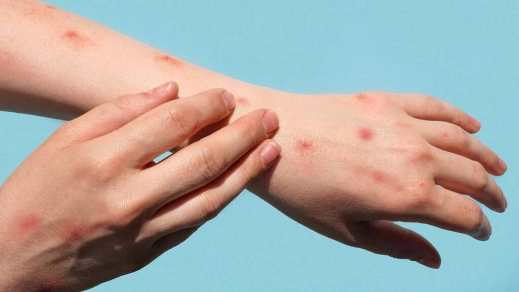 Para la OMS mpox sigue siendo emergencia de salud pública X5VPAIMD7FDXVAZ2777H6ETMO4