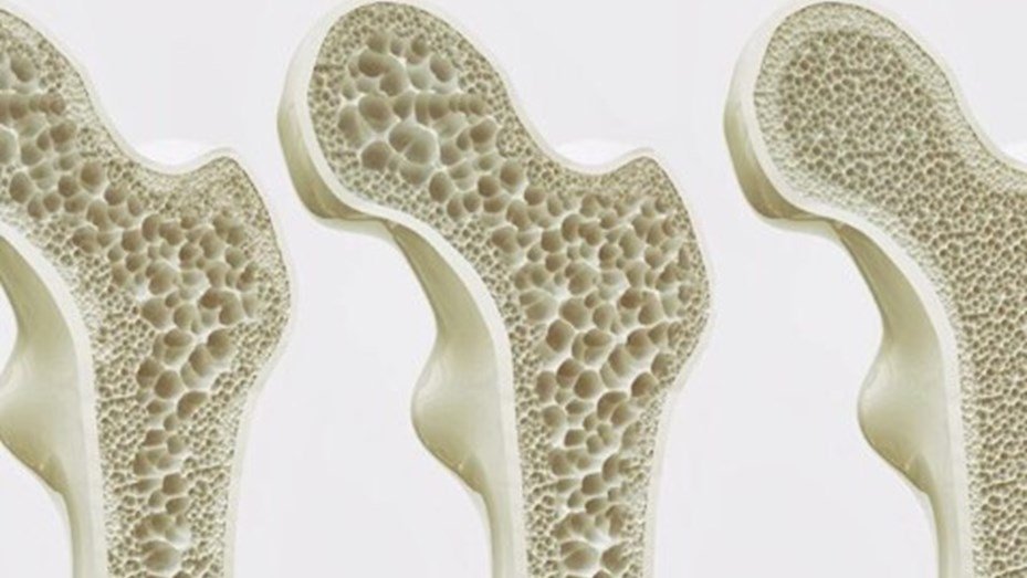 Osteoporosis: una de cada tres mujeres mayores de 50 años sufrirá una fractura por osteoporosis osteoporosis