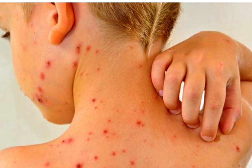 WEB 20220328 SARAMPION FOTO