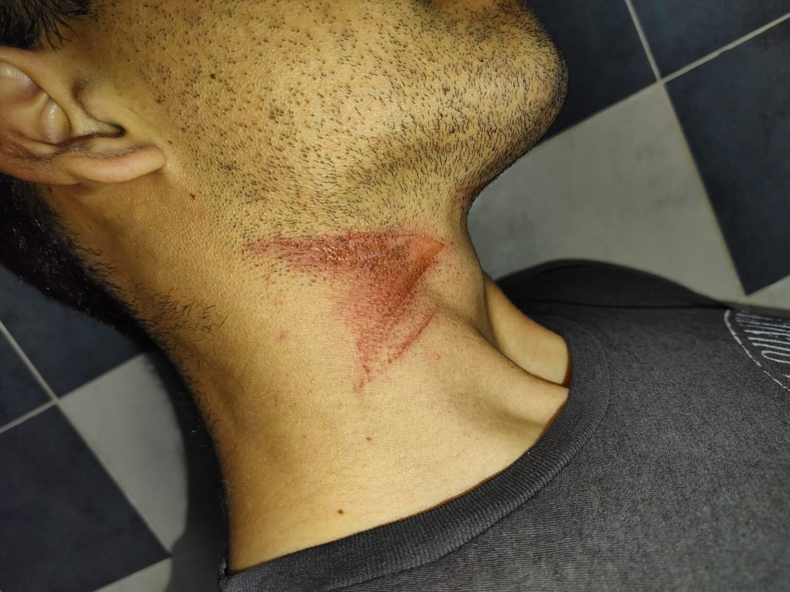 Motociclista sufrió lesiones tras enganchar un cable colgando en una calle oscura WhatsApp Image 2025 11 06 at 10.59.55 AM