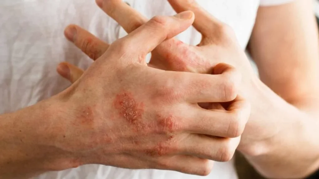 ANMAT aprueba en Argentina nueva terapia oral para artritis psoriásica en adultos 720 3