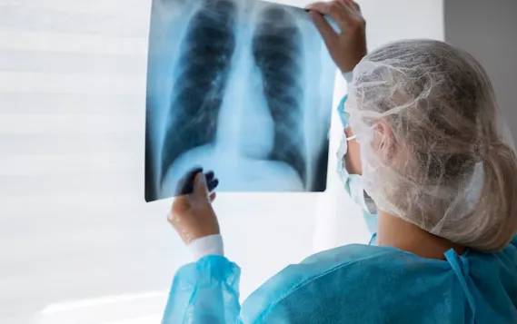 Peste neumónica: qué es y cómo se contagia peste neumonica